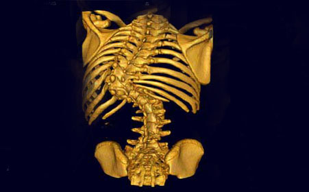 强直性脊柱炎认识上的五大误区
