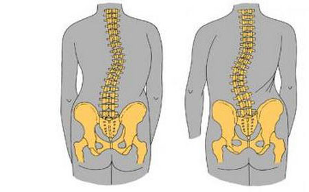强直性脊柱炎是怎么回事